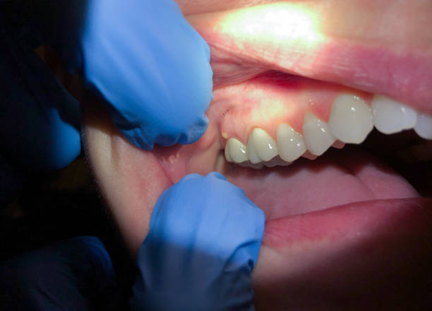 Best Emergency Dental Care for Broken or Chipped Teeth in Tower Lakes, IL